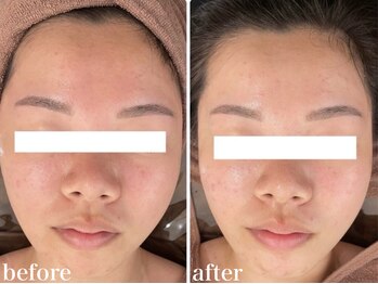 ホワイトアクア 北千住店(WHITE AQUA)/ハーブピーリング/肌質改善/毛穴