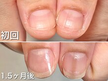 グラシュータン(gracieux temps)/【深爪矯正13000円】