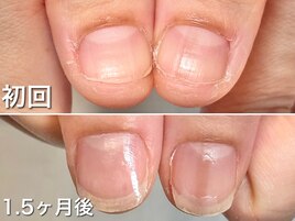 【深爪矯正13000円】