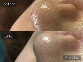 アムールサロン(Amour salon)/ハイドラ/毛穴洗浄/四谷三丁目