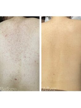 エミルカ 鹿児島店(EMILUCA)/ハーブピーリング 背中