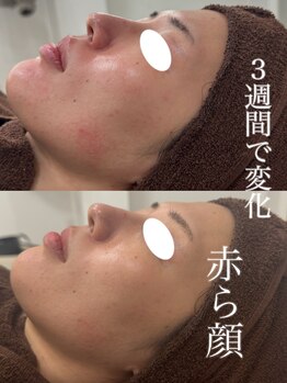 テンニック(10nick)/３週間で赤ら顔の変化