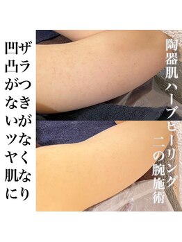 エムラボ 新宿店(M LABO)/二の腕ハーブピーリング