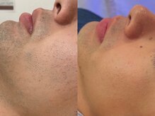 スリーズララ(Cerise LaLa)/ヒゲ脱毛のbefore→after