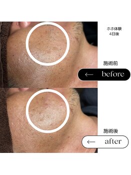 エスト(Est_.)/美容電気脱毛後の肌