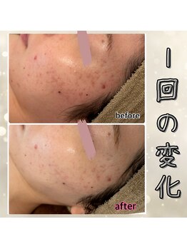 プルーム 久留米店(plume)/ハーブピーリング