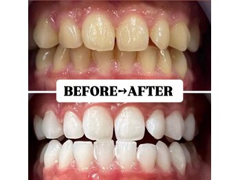 ホワイトニングサロン 豊中/Before&After美白ホワイトニング
