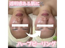 サロン(SALON)/ハーブピーリング