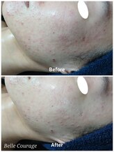 ベルクラージュ(Belle Courage)/30代　ニキビ