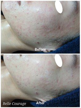 ベルクラージュ(Belle Courage)/30代　ニキビ