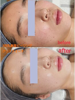 セレブリティ(Celebrity)/乳酸菌ピーリング アンストレス