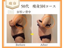 リュミエール(Lumiere)/【症例】背中脂肪撃退