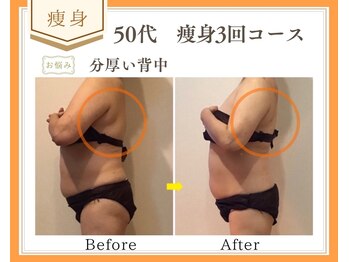 リュミエール(Lumiere)/【症例】背中脂肪撃退