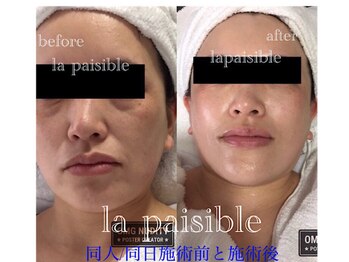 ラ ペジヴル(la Paisible)/小顔リフト効果抜群フェイシャル