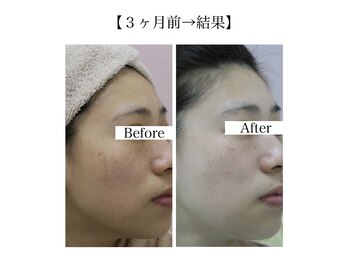 スマートポッシュ(Smart posh)/【シミケア】before→after