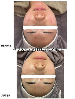 バブルビューティー(Bubble beauty)/サブスク2ヶ月目のお客様☆