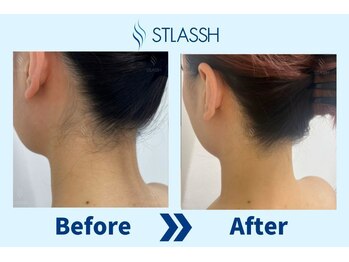 ストラッシュ 福岡天神店(STLASSH)/【ストラッシュ】お客様の施術例