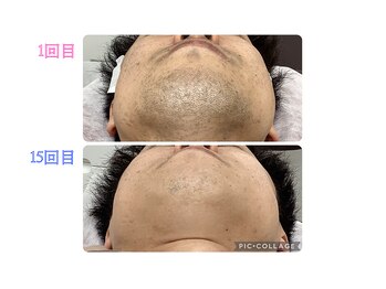 リオンズ 柏駅前店の写真/【人気No.1メンズ脱毛】清潔感で好印象。ヒゲ・全身・ワキ・VIO脱毛☆最新機器・肌ケア・通い放題で効果◎