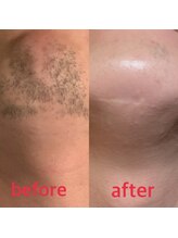 セブンスコード(7th CODE)/ヒゲ脱毛　　　Before→After