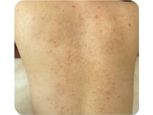 お顔そりローズマリー/ボディハーブピーリング