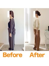 整体院ひなた 都城院/昔から悩む猫背/巻き肩が改善!!