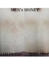 ハニーアイズ(Honey Eyes)/無駄な胸とお腹の毛！無くします