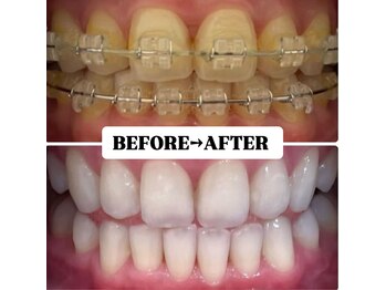 ホワイトニングサロン 豊中/Before&After美白ホワイトニング