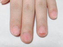 アネリー(ANERY.)/自爪育成・深爪育成