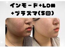 ライブ ストーリー(Live story)の雰囲気（LDM+インモード+プラズマ）