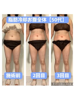 パラアモール(Paraamor)/地味だけど効いてる!脂肪冷却