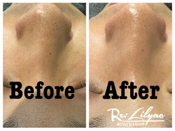 リリアック(Re:Lilyac)/Re:ilyac#ハーブピーリング