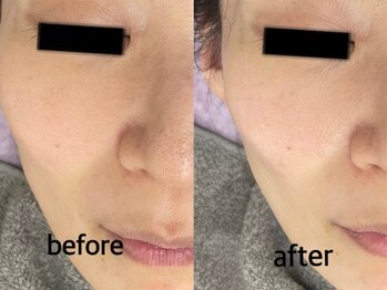 シェリー(Cheri)/毛穴洗浄+ピーリング+ヒアルロン