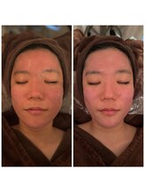 ドクター ヴィーナス/ハーブモニター3回