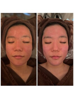 ドクター ヴィーナス/ハーブモニター3回