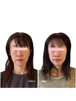 ニコディア(nico-dia)/美容鍼