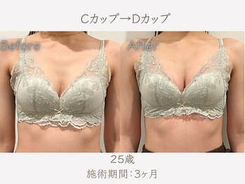 ハリスタ 梅田院(HARISTA)/3ヶ月間でCカップ→Dカップ