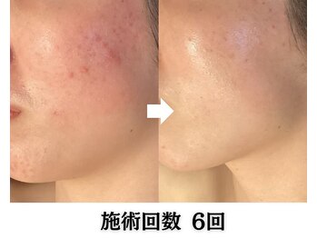 ハーブピーリング&毛穴洗浄専門店 肌REVO 高田馬場店[ニキビ/毛穴/たるみ/美白/シミ]/ハーブピーリング/ニキビケア