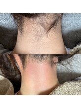 ルピナス(Lupinus)/うなじwax脱毛