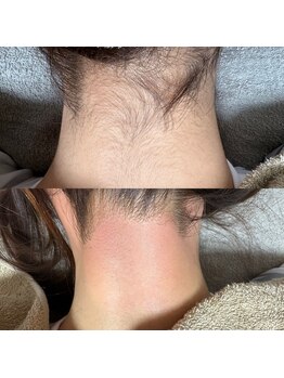 ルピナス(Lupinus)/うなじwax脱毛