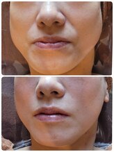 ムー ブランチ(Mou Branch)/プラズマフェイシャル