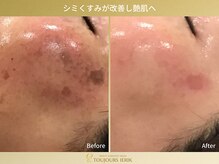 トゥジュール イエリック(Toujours ierik)/シミ・美白ケア