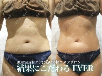 エヴァーグレース 宇都宮店の写真/憧れのくびれは韓国スリム美容「レモンボトル」で目指せスリム!!こだわり技術で理想のボディラインへ♪