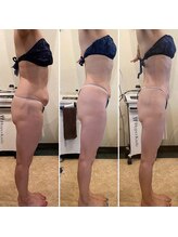 美肌工房ルノン(Lunon)/ダイエット：before／after