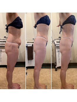 美肌工房ルノン(Lunon)/ダイエット：before／after