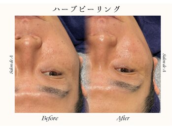 サロンドエー 帝塚山(Salon de A)/ハーブピーリング