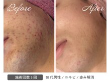 カシェボーテ(CACHE BEAUTE)/ニキビケア/プラズマ×幹細胞