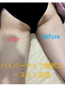 サロンドリドミ 新瑞橋店(Salon de ridomi)/ハイパーナイフボディ下半身