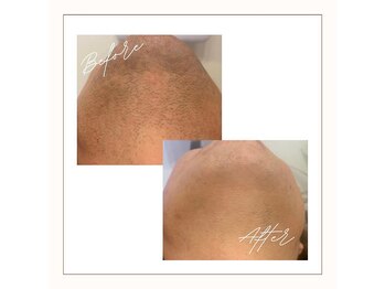 ラベニール(La Benir)/メンズ人気No.1ひげ脱毛