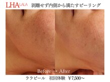 ビクトリー(VICTORY)/韓国肌管理ララピール