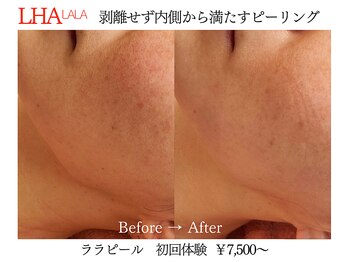 ビクトリー(VICTORY)/韓国肌管理ララピール